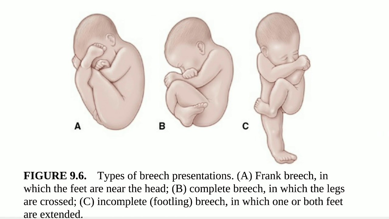 mean of breech presentation