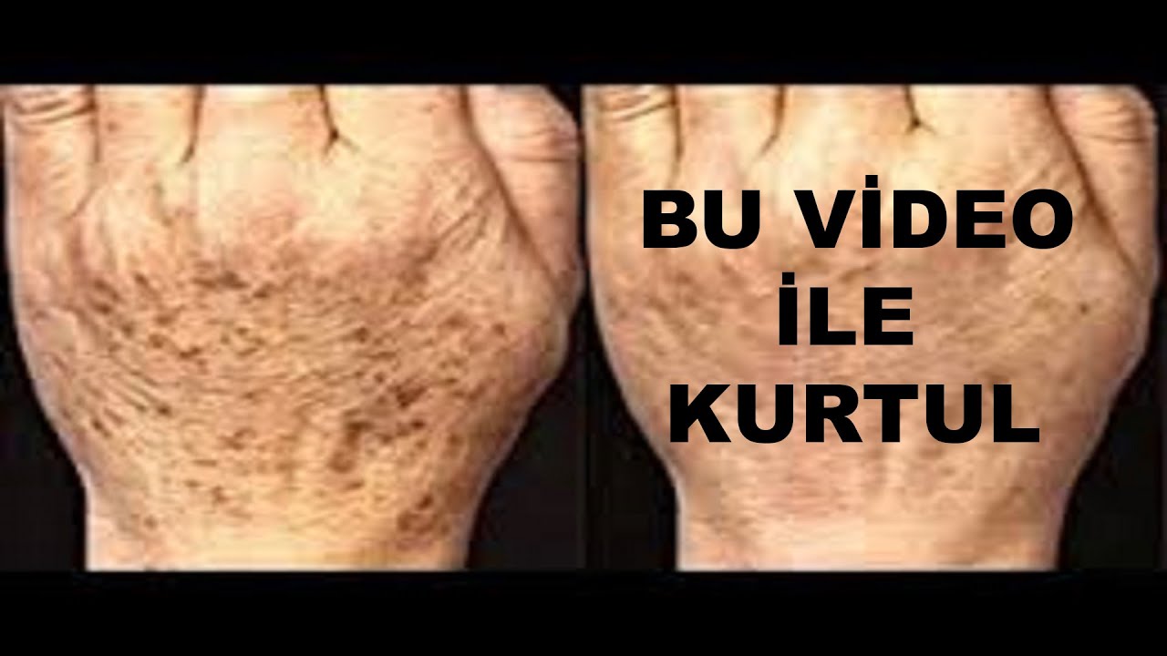 Yaslilik Lekelerinin Sasirtan Tedavisi Youtube Youtube Sac Tirnak Yaslilik Lekelerinin Sasirtan Tedavisi Youtube Youtube Sac Tirnak