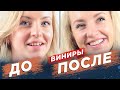 Керамические виниры. Ceramic veneers