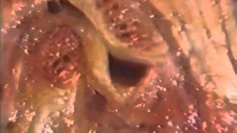 4  Anterior Disk Displacement with Reduction