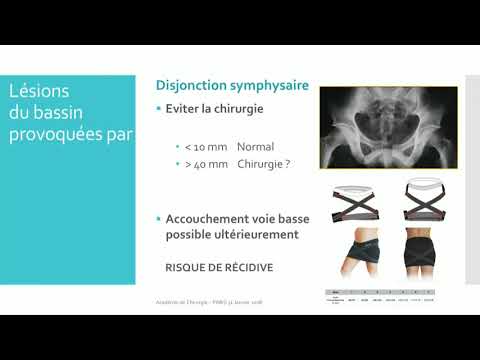 Vidéo: Avez-vous besoin d'une intervention chirurgicale pour une fracture du bassin ?