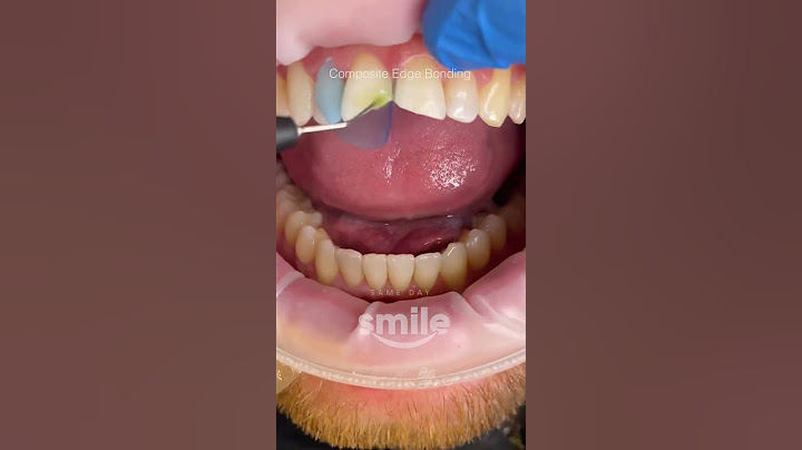 Composite edge bonding to repair chipped teeth✨ Such a drastic change for the patient #smilemakeover