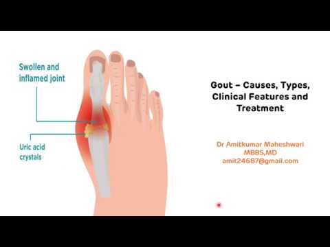 Video: Perkembangan Dalam Pemahaman Saintifik Dan Klinikal Mengenai Gout