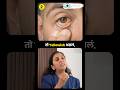 फक्त डोळे तपासून दुसरे आजार ओळखू शकतो का? #anemia #thyroid #eyehealth