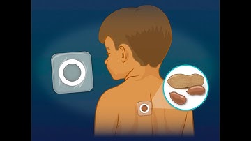 Epicutaneous Immunotherapy with Peanut Patch in Toddlers with Peanut Allergy | NEJM
