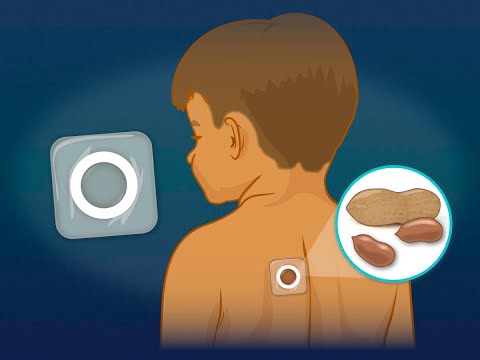 Epicutaneous Immunotherapy with Peanut Patch in Toddlers with Peanut Allergy | NEJM