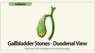Linear EUS: Gallbladder Stones - Duodenal View