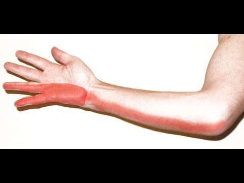 Vídeo: O Dedo Mínimo E O Anular Da Mão Esquerda Ficam Dormentes: Causas, Tratamento