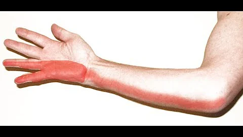 Como tratar neuropatia do nervo ulnar?
