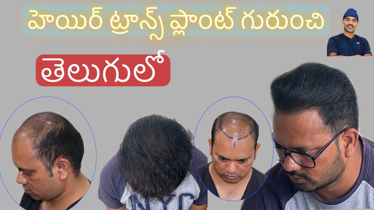 hair transplant vijayawad | Best Cost & Results hair transplant clinic in  vijayawada. - YouTube