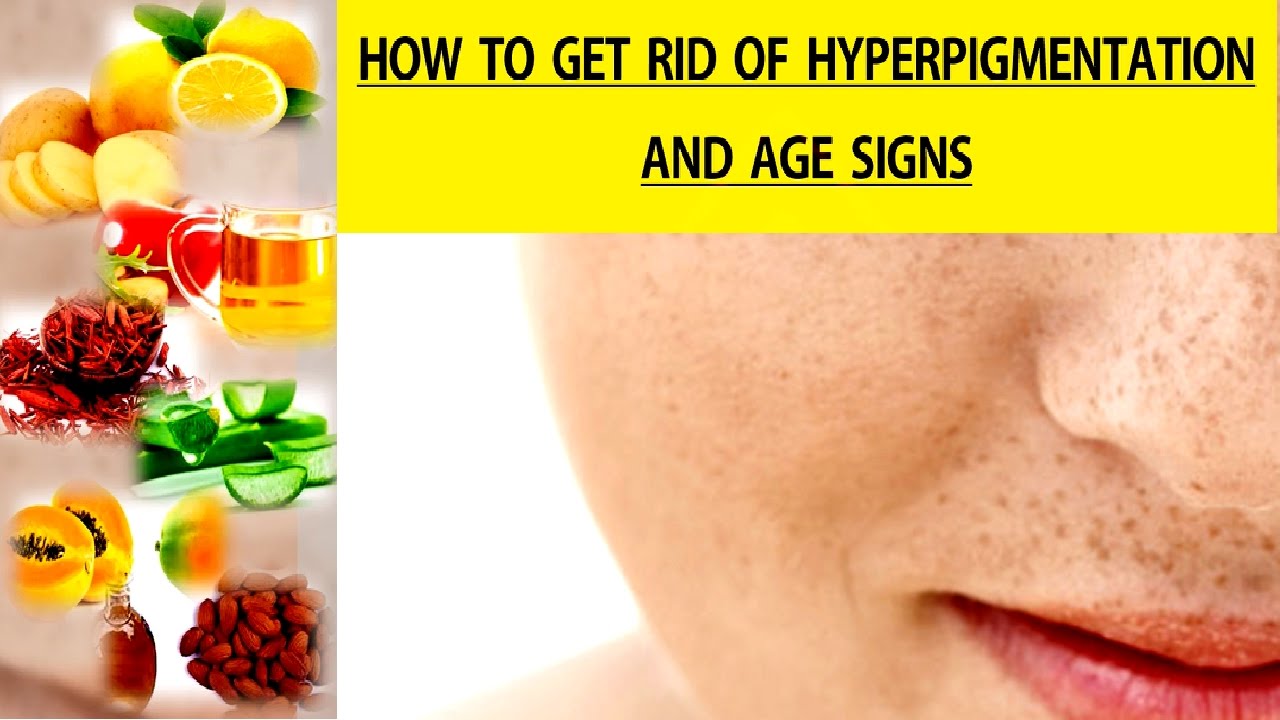 How To Get Rid Of Hyperpigmentation And Age Signs Youtube
