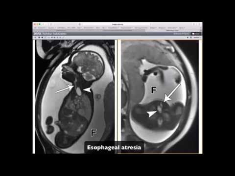 Fetal MR Imaging