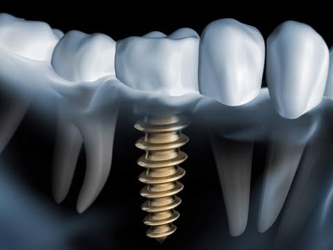 Welches Zahnimplantat System ist das beste?