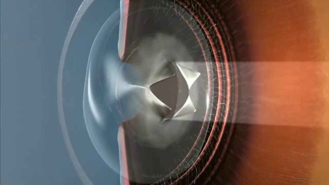 Вторичная катаракта. Что это и как ее лечить - YouTube