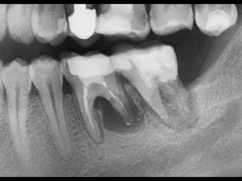 Video: Radikularna Cista: Simptomi, Liječenje, Operativni Zahvati, Uzroci