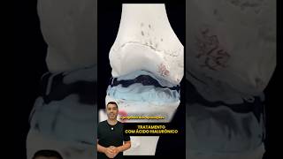 Tratamento de ÁCIDO HIALURÔNICO no joelho 💉#joelho #ortopedia #dornojoelho #acidohialuronico