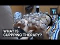 What is cupping therapy?