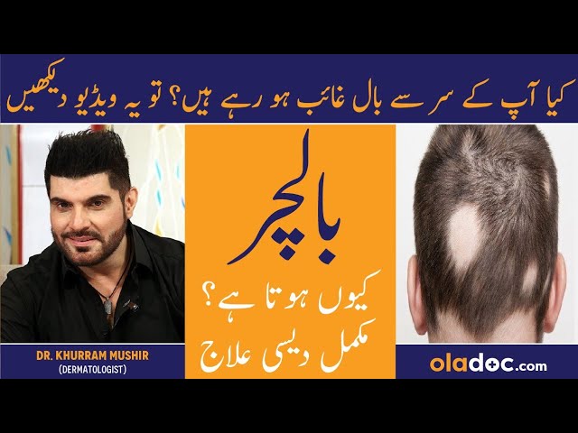 Baalchar Ka Elaj - Alopecia Areata Symptoms & Treatment Urdu - Alopecia Ka Ilaj - Patchy Hair Loss class=