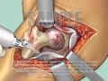 Total Hip Replacement Surgery: Medical Animation