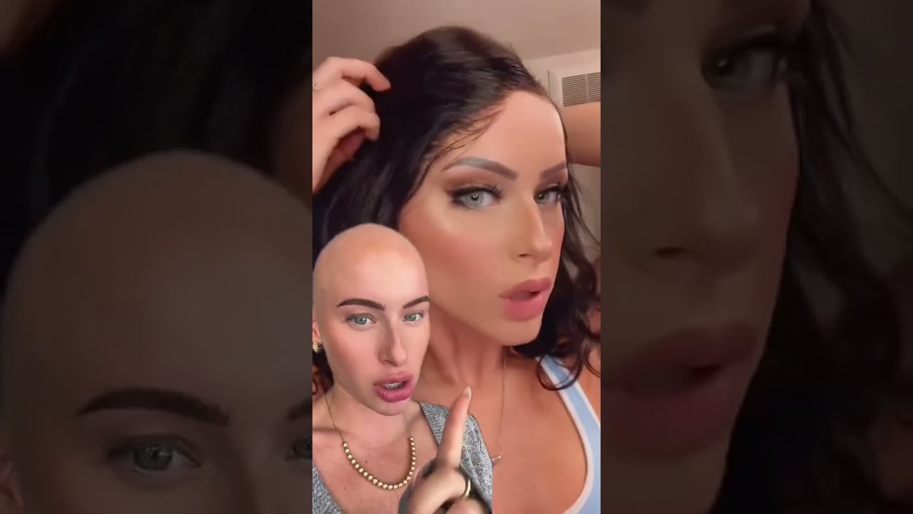 I AM SPEECHLESS Wigtransformation Wighelp Wiginstall Transformation Bald Alopecia