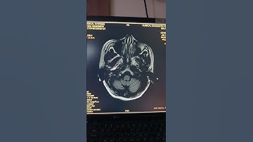 MS (Multiple sclerosis) #mri #beginners #mritech #like #subscribe #like