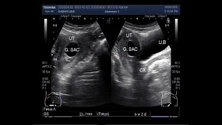 Ultrasound showing an empty Gestational sac in pregnancy of about 6 weeks 2 days