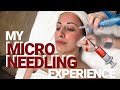 What Microneedling is REALLY Like | My Microneedling Experience | LASH BOSSES