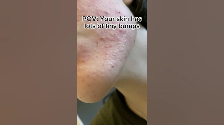 3 simple ways to get rid of tiny bumps in 1 month