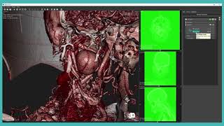 Vesalius3D Scissors Net Worth