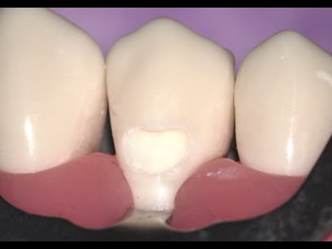 #5 Buccal Amalgam Preparation