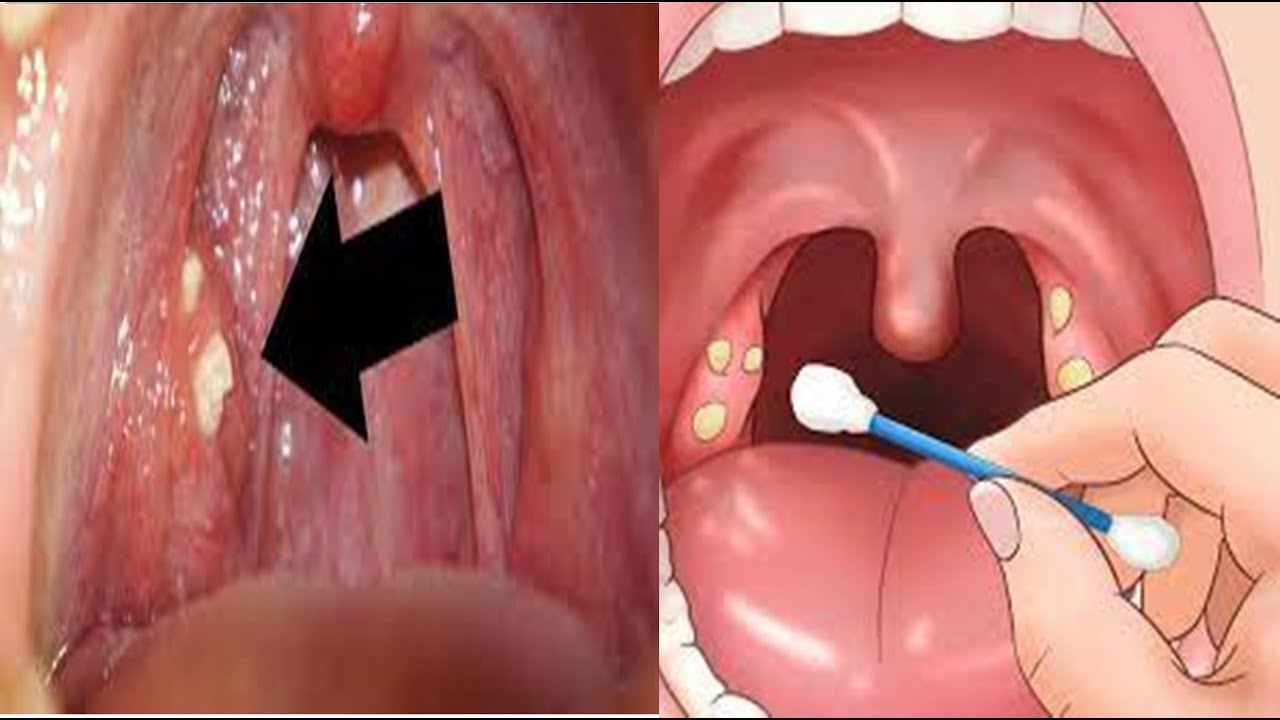 Como quitar el picor de garganta y tos