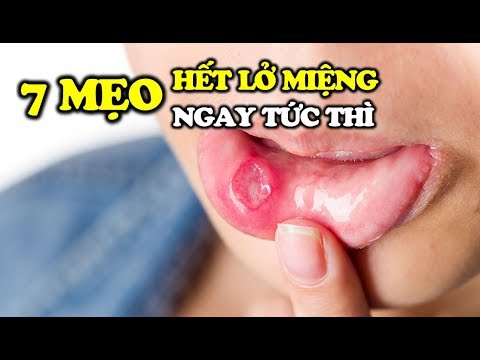 [Bài thuốc quý] Lở loét miệng gây đau đớn: Nên thử 7 cách chữa bằng thực phẩm đơn giản