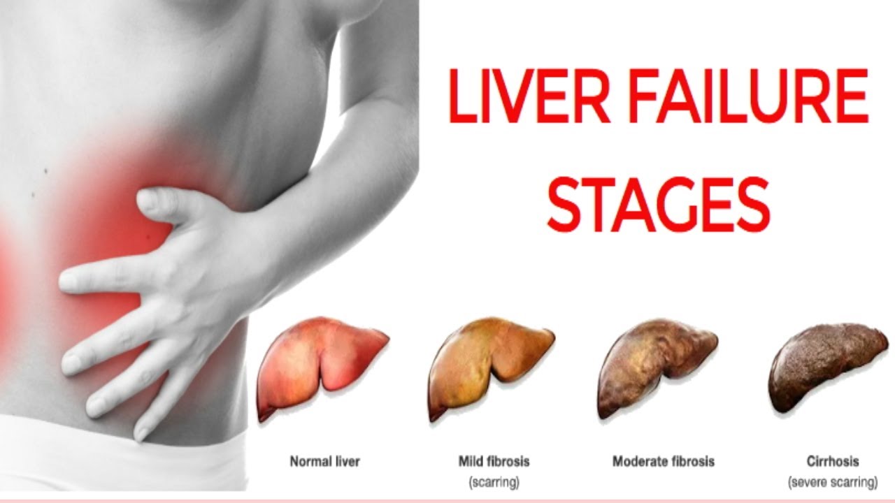 LIVER FAILURE STAGES YouTube