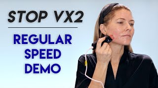 Tripollar STOP Vx2 Radio Frequency Device  Normal Speed Demo