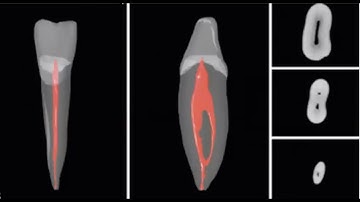 Giải phẫu nội tuỷ răng trước và răng cối nhỏ