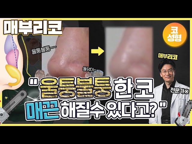 울퉁불퉁한 매부리코, 이렇게 쉽게 매끈해질수 있다고요?  [우리성형외과의원]