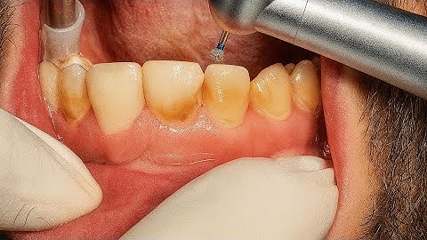 Composite Veneer for Badly Decayed Anterior Teeth | Step-by-Step Restoration