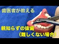 【横浜戸塚　内藤歯科】親知らずの抜歯（難しくないタイプ）Wisdom teeth