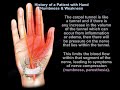 Carpal Tunnel Syndrome  symptoms and treatment - Everything You Need To Know - Dr. Nabil Ebraheim