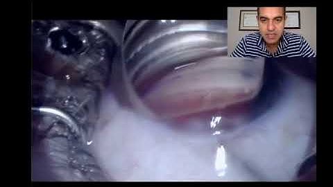 iStent Inject Compilation: gen 2 / gen 3 / Correcting over-implantation