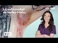 La Dra Emma se enfrenta a la enfermedad de Hailey -Hailey | Dra Emma: clínica dermatológica