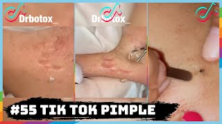 #55 TIK TOK PIMPLE VIDEO COMPILATION US UK | 29th August 2020