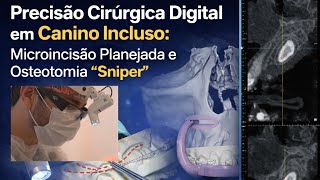 Precisão Cirúrgica Digital em Canino Incluso: Microincisão e Osteotomia "Sniper”