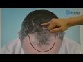 2  preoperative appointment and checkup  hrbr hair restoration blackrock