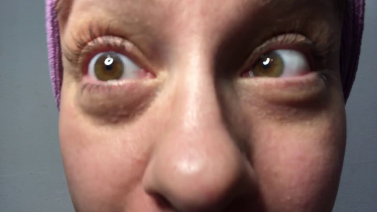 BEFORE Milia treatment- Skin Classic 