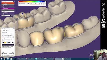 3D Printed Temporaries with ExoCAD:  Bridge Connectors