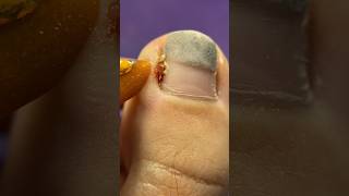 ФАС! 😂 врос ноготь - перевоплощение 🤩 педикюр #tutorial #nails #nailart #nails #pedicure #wow