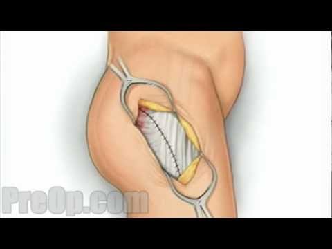 Hip Replacement Surgery - PreOp Patient Education Medical HD