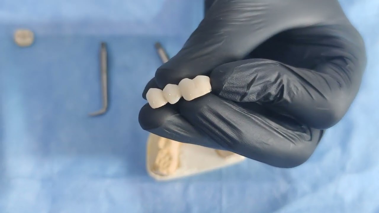 how to remove crown and bridge