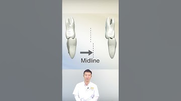 Bị Lệch Nhân Trung Và Cải Thiện Bằng Niềng Răng?! | Nha Khoa Minh Châu